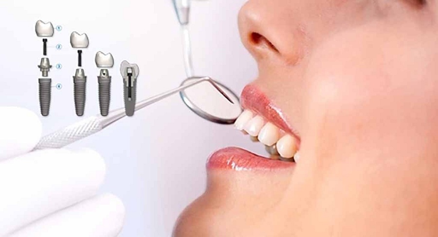 What is to know about immediate dental implants? Check out these tips