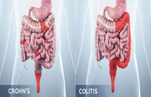 Crohn's disease and ulcerative colitis