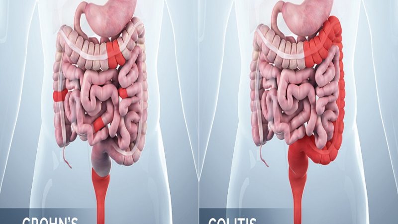 Differences between Crohn’s disease and ulcerative colitis