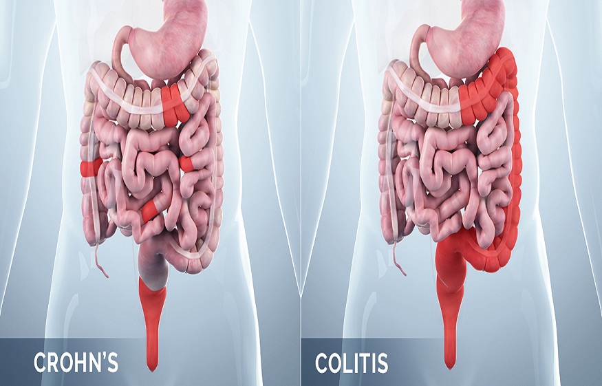 Differences between Crohn’s disease and ulcerative colitis